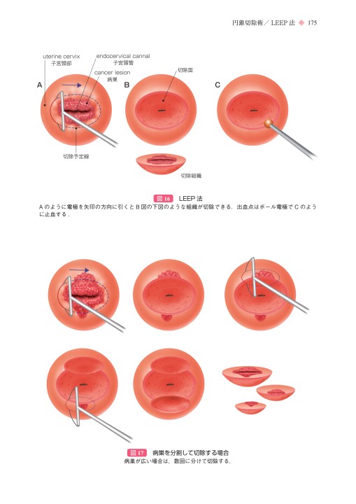 即日発送】 [A11603058]新しい無結紮婦人科手術の実際―子宮摘出術